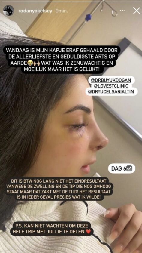 rodanya nieuwe neus