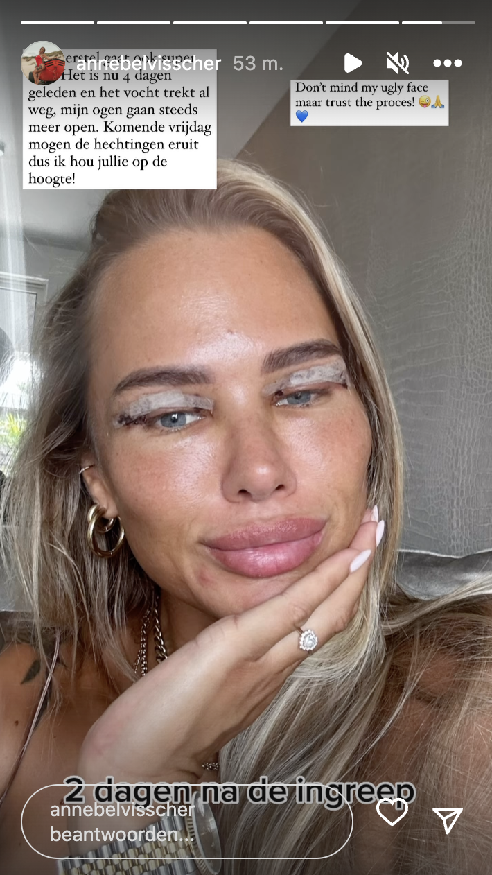 annebel visscher ooglidcorrectie